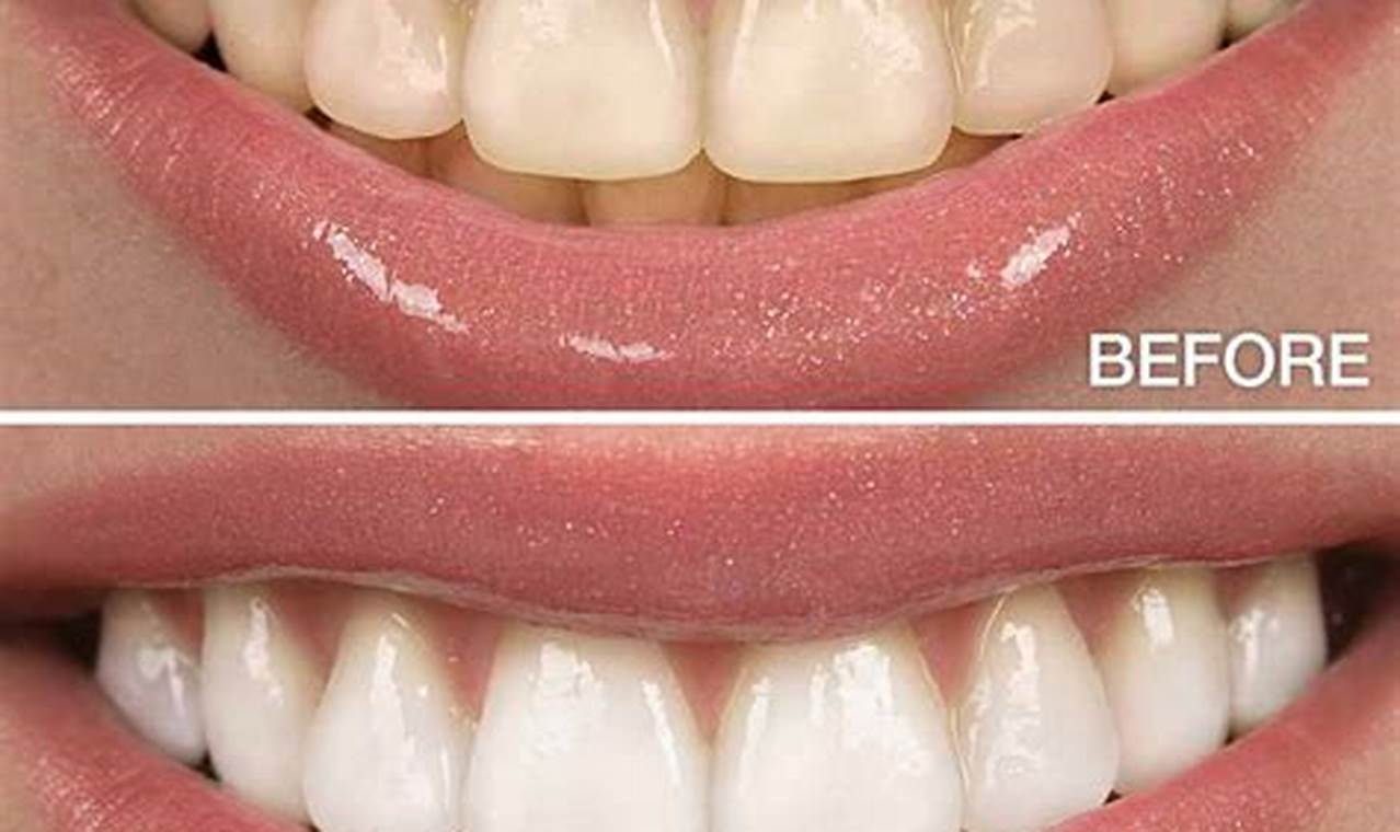 How Long After White Capping Do Teeth Erupt
