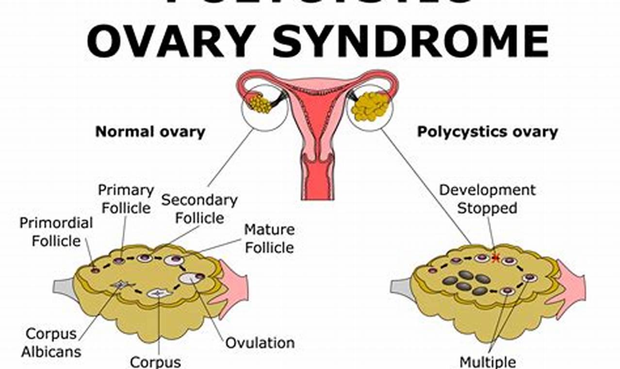 How to Get Pregnant with PCOS and Regular Periods: A Comprehensive Guide