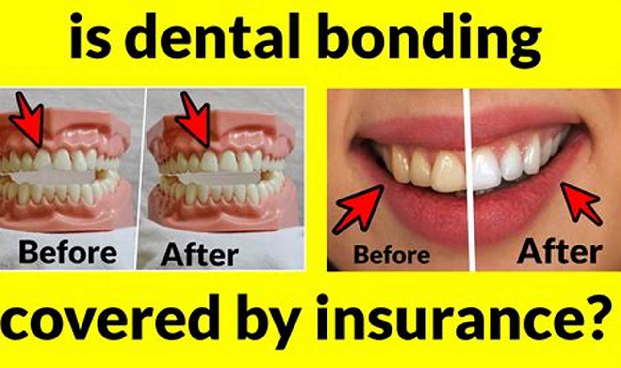 Unveiling Dental Bonding Insurance Coverage: A Comprehensive Guide