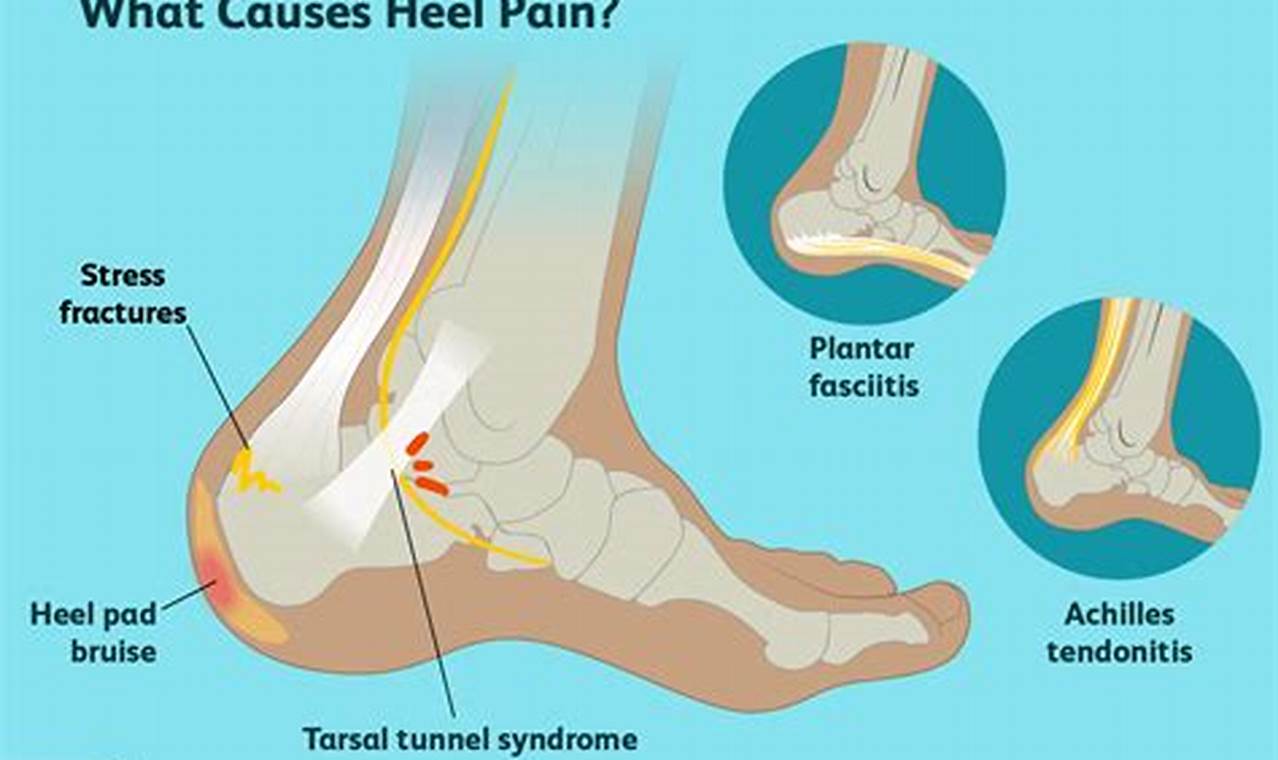 Pain in Heel After Ankle Sprain