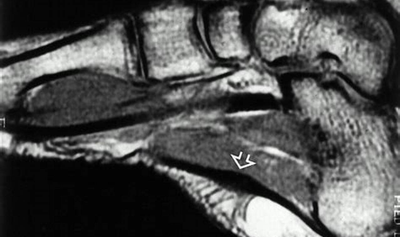 Severe Plantar Fasciitis MRI Images