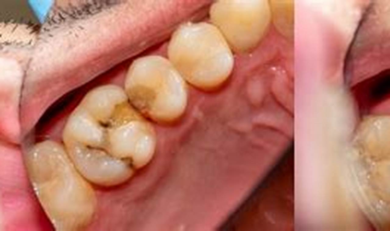 Pentingnya Tambal Gigi yang Perlu Anda Pahami