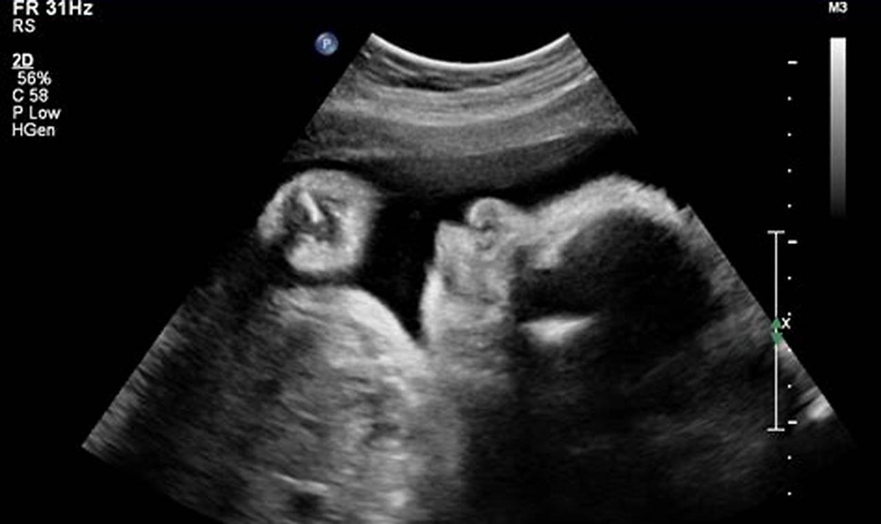 Unlocking Your Baby's World: Ultimate Guide to Ultrasound Pics at 32 Weeks