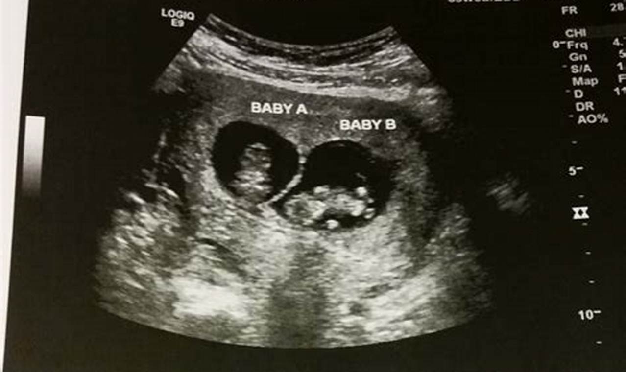 Unveiling Your Pregnancy: A Guide to Ultrasound Pictures at 10 Weeks