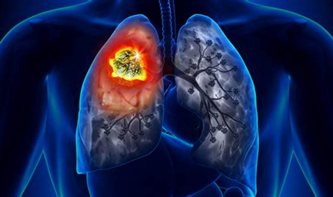 Lungenkrebs: Metastasen verstehen und neue Hoffnung schöpfen