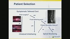 Spinal Column Shortening for Recurrent Tethered Spinal Cord