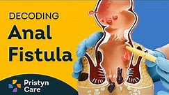 Decoding Fistula | Fistula: Causes, Symptoms, and Treatment Options