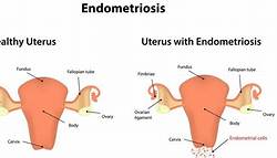 Endometriosis dan Fundus Uteri