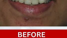 Transforming Smile With Direct Partial Veneers | Smile Makeover | Dental Transformation