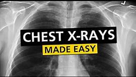 Chest X Rays (CXR) Made Easy! - Learn in 10 Minutes!