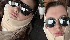 Ireland Baldwin Shares Post-'FaceTite' Recovery Selfie On Instagram