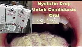 Dosis dan Cara Penggunaan Nystatin drop untuk Pengobatan sariawan dan Jamur mulut/ Candidiasis oral