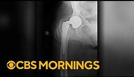 Titanium hip implants snapped in hundreds of people, took years before some products recalled