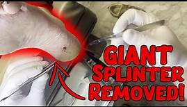 Splinter Removal: Watch as We Extract a Massive Splinter from a Patient's Heel!