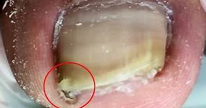 There is a sharp corner at the front of the ingrown toenail! Dig out【Crazy pedicure room】
