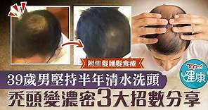 【脫髮困擾】39歲男半年堅持清水洗頭　禿頂變濃密3大招數分享 - 香港經濟日報 - TOPick - 健康 - 健康資訊