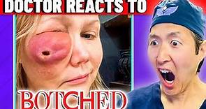 Plastic Surgeon Reacts to BOTCHED: Facial Fillers Did THIS?!?