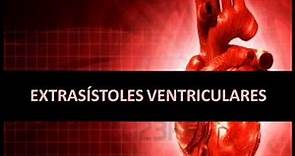 Arritmias cardíacas - Extrasístoles ventriculares