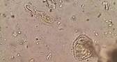 Microbiology - Giardia lamblia cyst and trophozoite in Stool