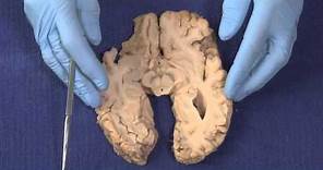 Basal Ganglia: Neuroanatomy Video Lab - Brain Dissections