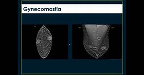 Imaging the Male Breast- Imaging 2022