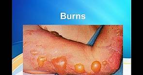 Burns: Classification and extent