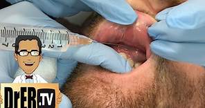 gum abscess drainage - Full VIDEO