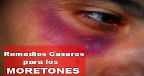 Remedios Caseros para Quitar los Moretones - Contusiones, Hematomas o Golpes - Eliminar Moretones