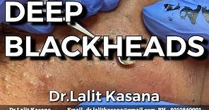 DEEP OLD BLACKHEADS REMOVAL BY Dr.Lalit Kasana (24 Jan. 2020)
