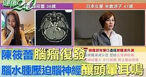 陳筱蕾腦瘤復發 腦水腫壓迫腦神經釀頭暈、耳鳴 健康2.0