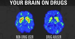 How addiction changes your brain