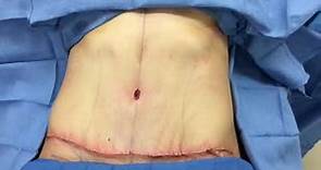 Tummy Tuck Before, During Surgery, and After