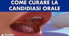 CANDIDIASI orale - Come CURARE la candida in bocca e CHEILITE angolare ©