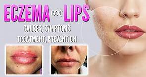 Eczema on lips causes, symptoms, treatment, remedies, prevention | Lip dermatitis, Lip Cheilitis