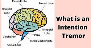 What is an Intention Tremor