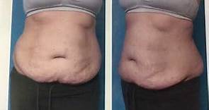 Tummy Tuck Surgery Before and After! #tummytuck #cosmeticsurgery