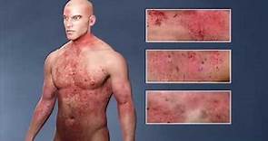 Atopic Dermatitis, (eczema); From the Inside Out