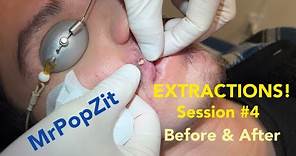 Severe Acne extractions. Session 4, amazing before and after! So many pops!