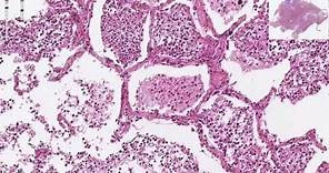 Histopathology - Bronchopneumonia