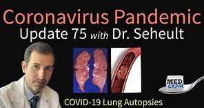 Coronavirus Pandemic Update 75: COVID-19 Lung Autopsies - New Data