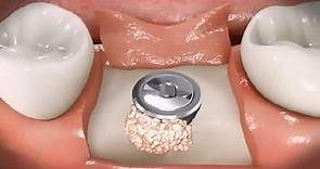 骨粉植入过程和种植牙全过程！