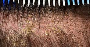 Scalp Eczema: Causes, Symptoms, Treatments & Preventive Tips