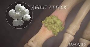 What Happens During a Gout Attack | WebMD