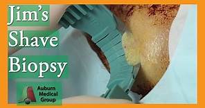 Jim's Forehead Shave Biopsy for Basal Cell Carcinoma | Auburn Medical Group