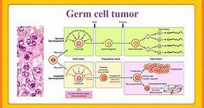 germ cell tumor