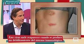 Tipos de herpes y cómo tratarlos con el Doctor Mariscal - Estando Contigo