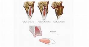 Traumatismos Dento-Alveolares