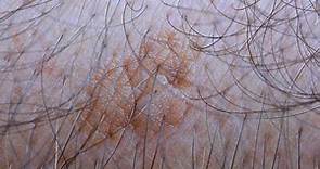 How To Remove Actinic Keratosis At Home | Bestdoctornearme.com -