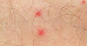 What is Petechiae, and What are its Causes.