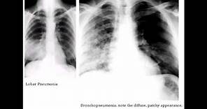 Lobar Pneumonia & Bronchopneumonia - Organisms & Characteristics